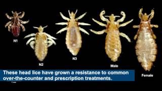 Household product safely cures drug resistant head lice [upl. by Roosnam]