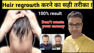 Hair linehair regrowth करने का सही तरीका  100 hair regrowth result [upl. by Eseerehs]