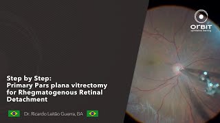 Step by Step Primary Pars plana vitrectomy for Rhegmatogenous Retinal Detachment [upl. by Hauser392]