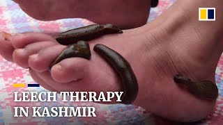 Kashmir residents seek leech therapy on Navroz [upl. by Brunhild]