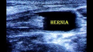 Inguinal Hernia ultrasound [upl. by Pazice387]