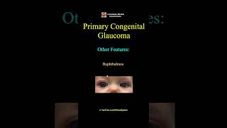 Primary Congenital Glaucoma Triad [upl. by Macguiness]