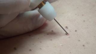 Hyperkeratosis removal with Plexr [upl. by Teresina174]