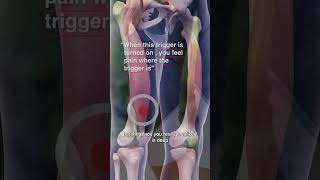 Are Vastus Medialis Trigger Points Causing Your Knee Pain [upl. by Silevi]