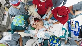 Conjoined twins survive 26hour separation surgery  Mashable [upl. by Lemuela]