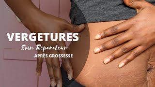 VERGETURES  SOIN REPARATEUR APRES GROSSESSE [upl. by Aicilla]