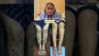 Lichen Planus Recovery Story How Homeopathy Healed Severe Skin Lesions  Psoriatreat Clinic [upl. by Doownil650]