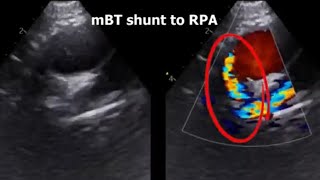 Echo imaging after single ventricle operations [upl. by Adnilemre]