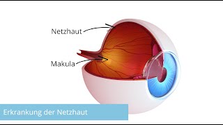 Netzhauterkrankungen Ursache Symptome Diagnose und Therapie in 3 Minuten von augenchirurgieorg [upl. by Ameg209]