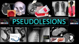 PSEUDOLESIONS [upl. by Oretos109]