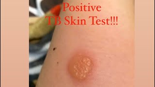 POSITIVE TB SKIN TEST [upl. by Eidaj]