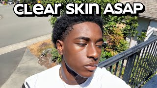 how to get clear skin for guys asap [upl. by Lil131]