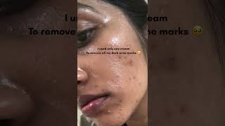 Acne scar removal with just one cream🫢♥️ shorts acne acnetreatment skincare skincareroutine [upl. by Woodsum]