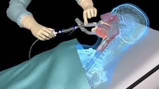 Suctioning the endotracheal tube  medical animation [upl. by Cassiani]