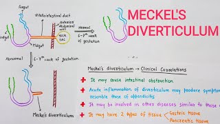 Meckels Diverticulum With Clinical Correlations [upl. by Joana867]