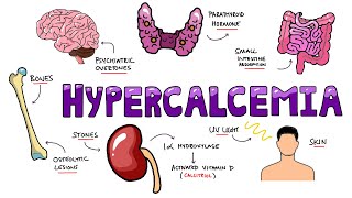 An Approach to Hypercalcemia  Causes Calcium Homeostasis Mechanisms amp Signs and Symptoms Mnemonic [upl. by Eerual]