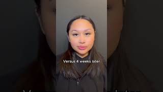 Botox Masseter Transformation  Before and After Masseter Botox [upl. by Annair828]