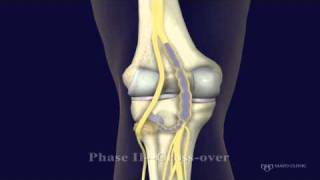 Peroneal and Tibial Intraneural Ganglion Cysts in the Knee Region Video 2 [upl. by Oaht]