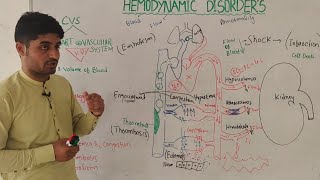 overview of hemodynamic disorders in hindi  hemorrhageshock infarction edema etc  by Dr aqib [upl. by Ddene]