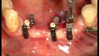 Narrow ridge flapless implant surgeryDr Young Keun Hyun [upl. by Locklin]