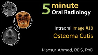 Osteoma Cutis Intraoral radiographic interpretation [upl. by Nomelihp]