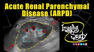 Acute Renal Parenchymal Disease  Ultrasound  Case 333 [upl. by Inahc]