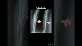 Fraktur radius xray radiology patahtulang radius [upl. by Yousuf168]