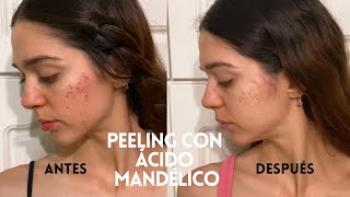 EXPERIENCIA CON PEELING DE ÁCIDO MANDÉLICO  Acné hiperpigmentación piel sensible [upl. by Reyotal]