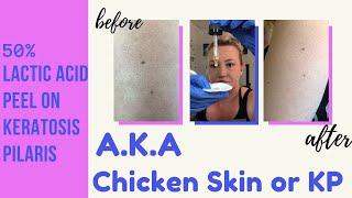 Lactic Acid Peel for Keratosis Pilaris  KP Selfcare Sunday [upl. by Salem245]