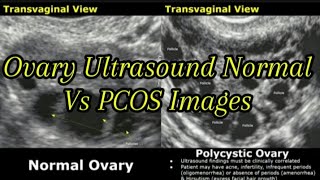 Ovary Ultrasound Normal Vs Polycystic Ovarian Syndrome PCOS Images  String Of Pearls Sign Ovaries [upl. by Atikan]