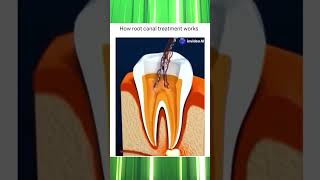 Everything You Need to Know About Root Canal Treatment  Dental Care Explained [upl. by Nura]