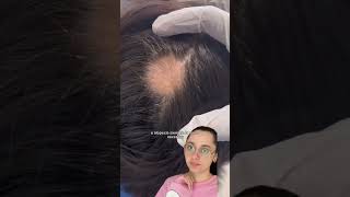 Cómo hacer crecer el cabello rápido l La verdad del MINOXIDIL [upl. by Yun]