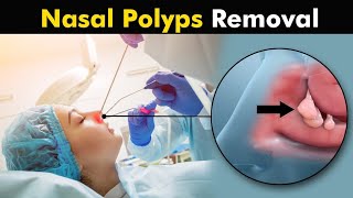 Nasal Polyps and their treatment  How Polypectomy is Performed [upl. by Diane168]