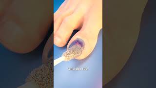 How Toenail Removal Works 😳 short [upl. by Nailluj]