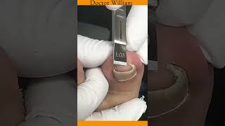 Ingrown Toenail Extraction Video [upl. by Suiraj637]