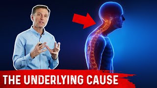 Scoliosis Kyphosis Lordosis and Vitamin D Explained by DrBerg [upl. by Yorke]