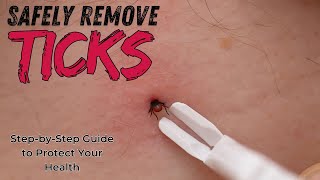 Safely Remove Ticks StepbyStep Guide to Protect Your Health [upl. by Anoved261]