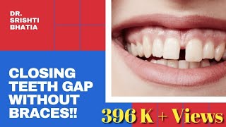 How to close gaps between teeth WITHOUT BRACES FAST Dr Srishti Bhatia GapAligner [upl. by Iaj]