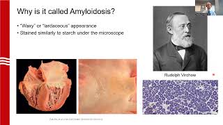 Demystifying Amyloidosis An Internists Guide to Early Recognition [upl. by Tenrag]