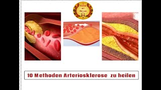 10 Methoden Arteriosklerose auf natürliche Weise zu heilen [upl. by Anirtep]