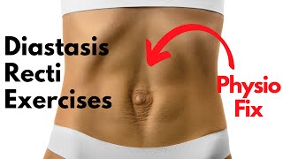 How to START Diastasis Recti Exercises that FIX YOUR GAP  PHYSIO GUIDED Abdo Separation Repair [upl. by Aicala]