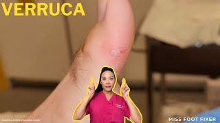 Quick amp Effective Verruca Removal Advanced Treatments Explained  Miss Foot Fixer [upl. by Bysshe]