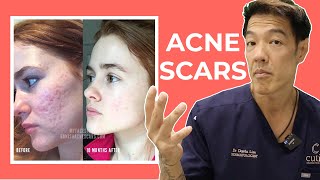 The Best Acne Scar Treatments Explained  Dr Davin Lim [upl. by Are180]