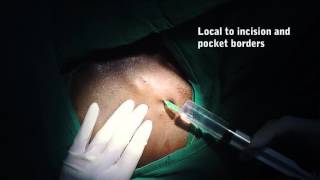 Injection of local anaesthetic after venous access [upl. by Zindman]