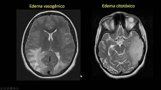 Edema cerebral [upl. by Annig]