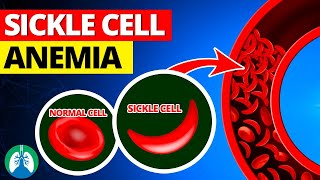 Sickle Cell Anemia  Quick Explainer Video [upl. by Alma]