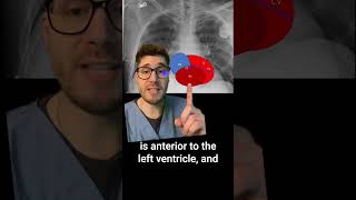 Pacemakers vs ICDs on Xrays 🩻🫀 [upl. by Enyar]