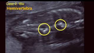 Ultrasound anomalies of fetal spine [upl. by Eneryt]