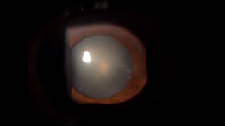 Posterior subcapsular cataract [upl. by Alphonse]