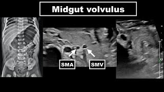 Midgut volvulus [upl. by Irrep]